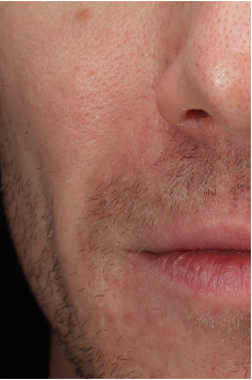 Acne actief after