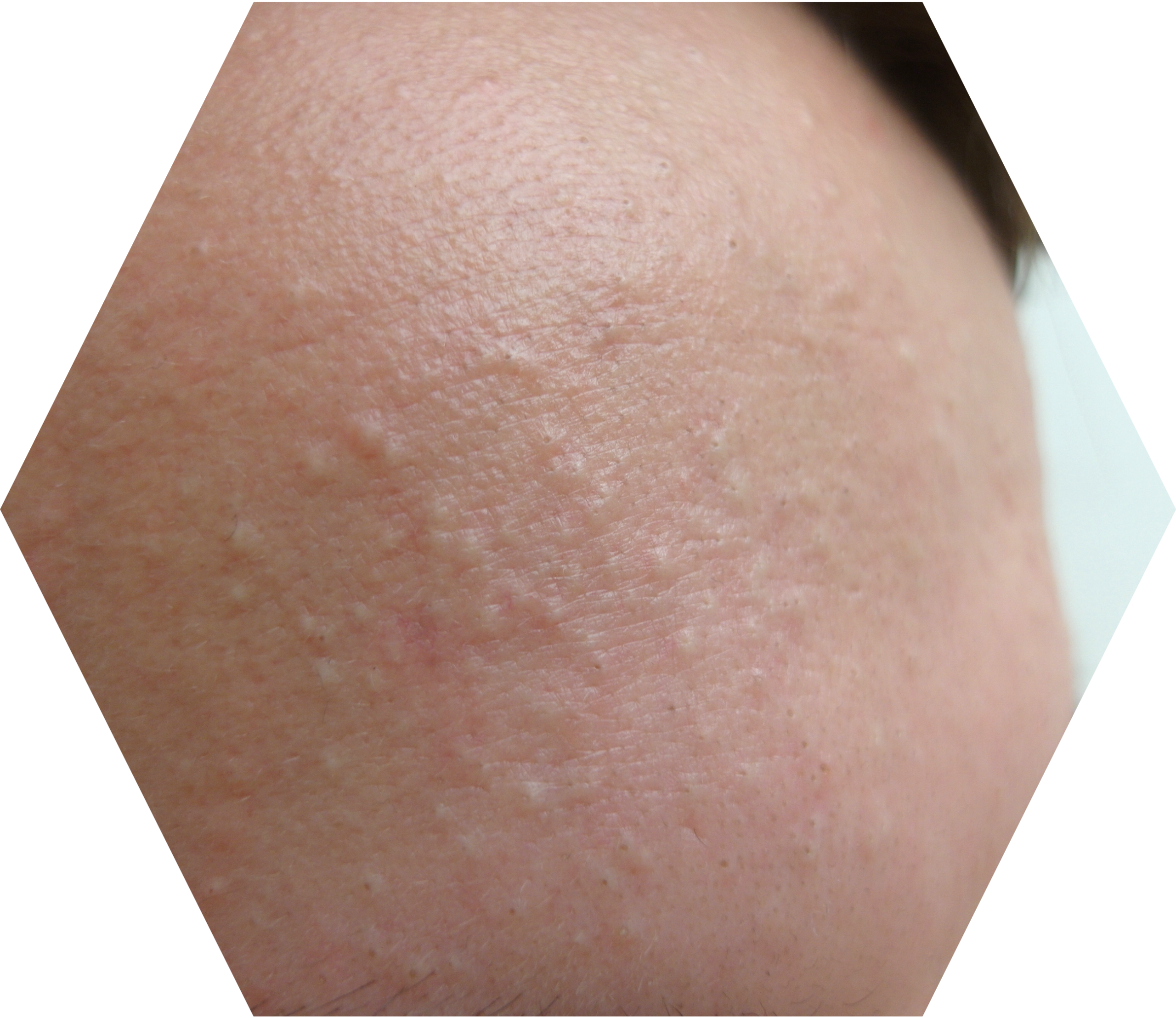 Acne comedonica