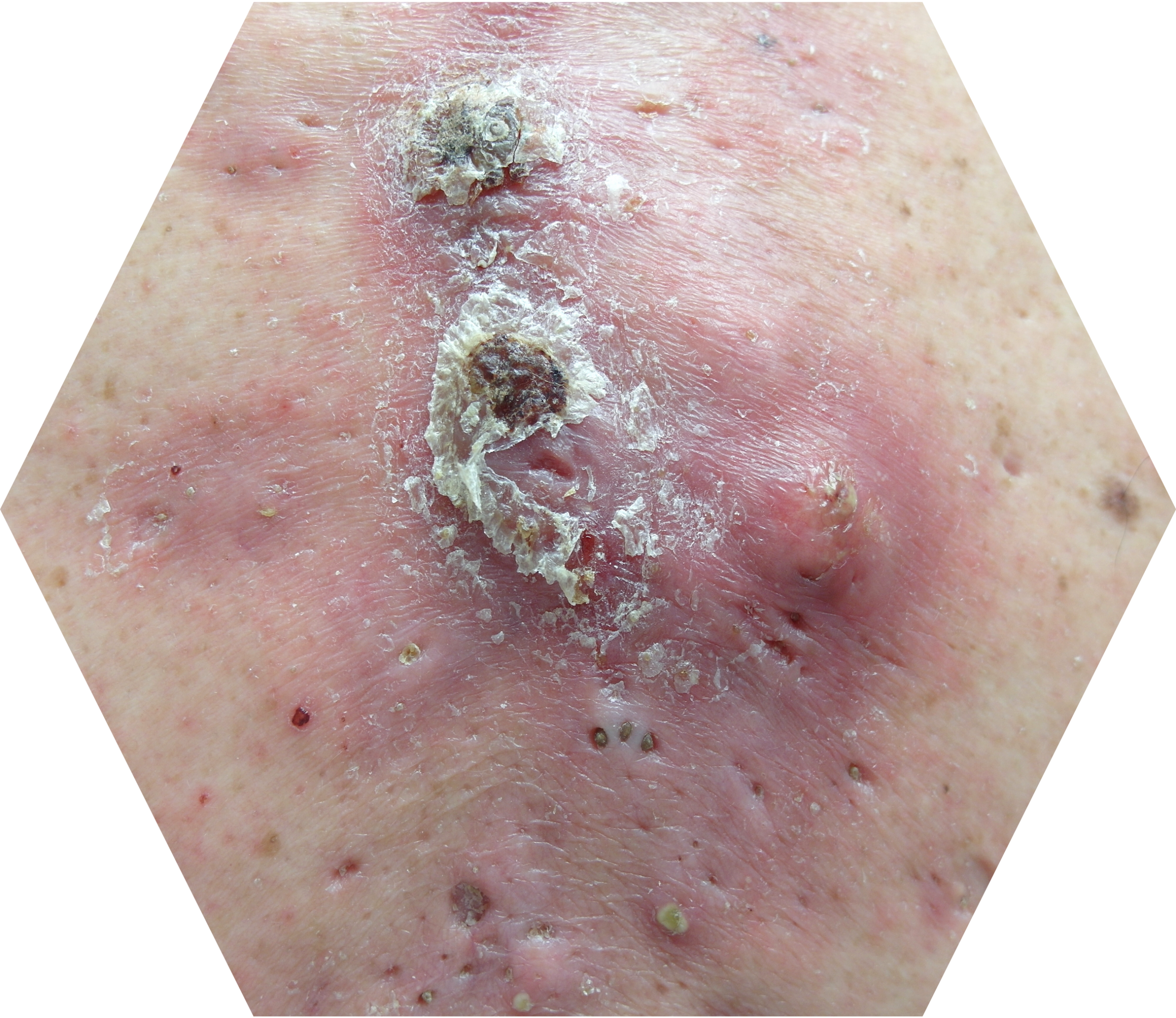 Acne conglobata
