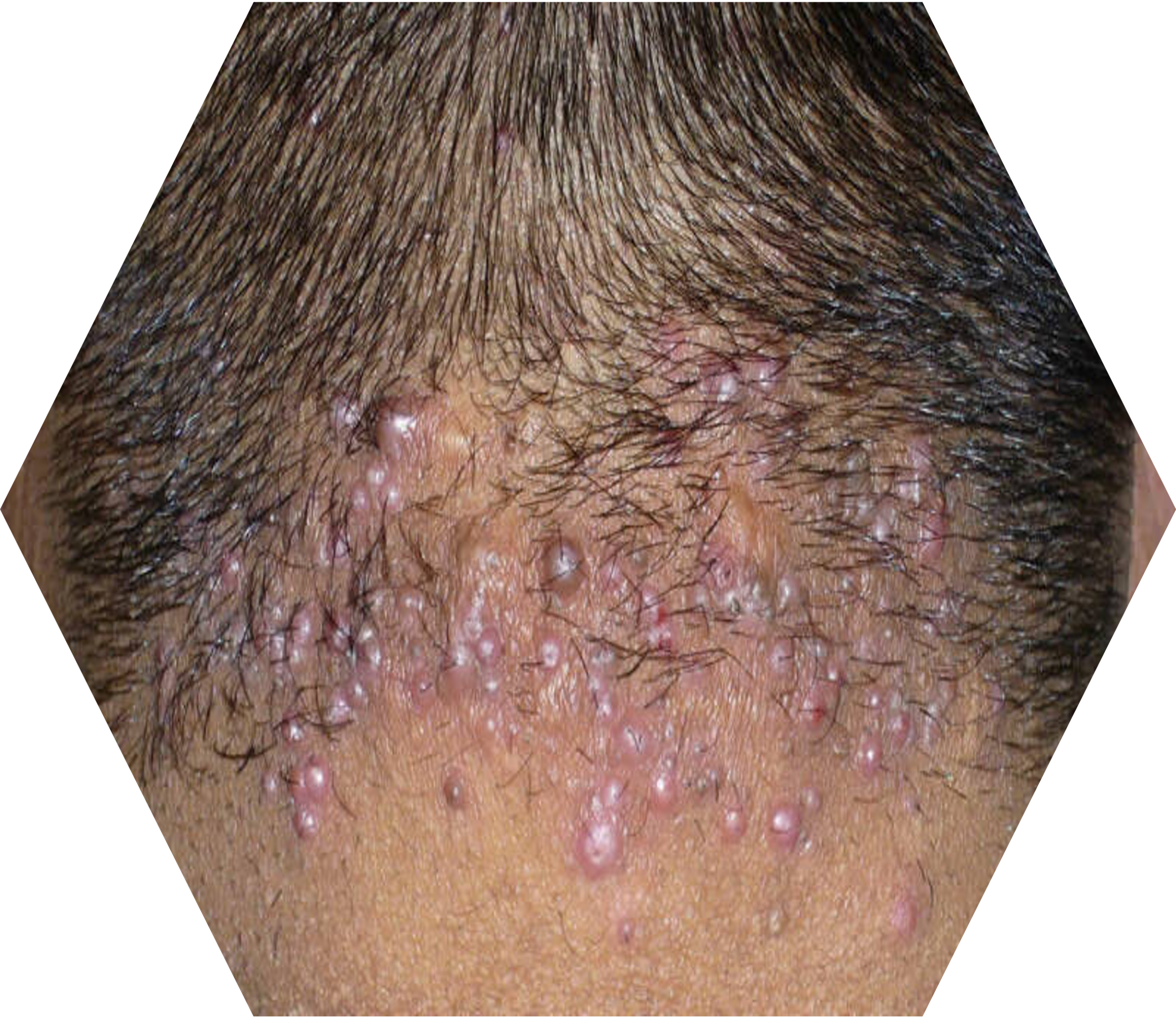 Acne keloïdalis nuchae