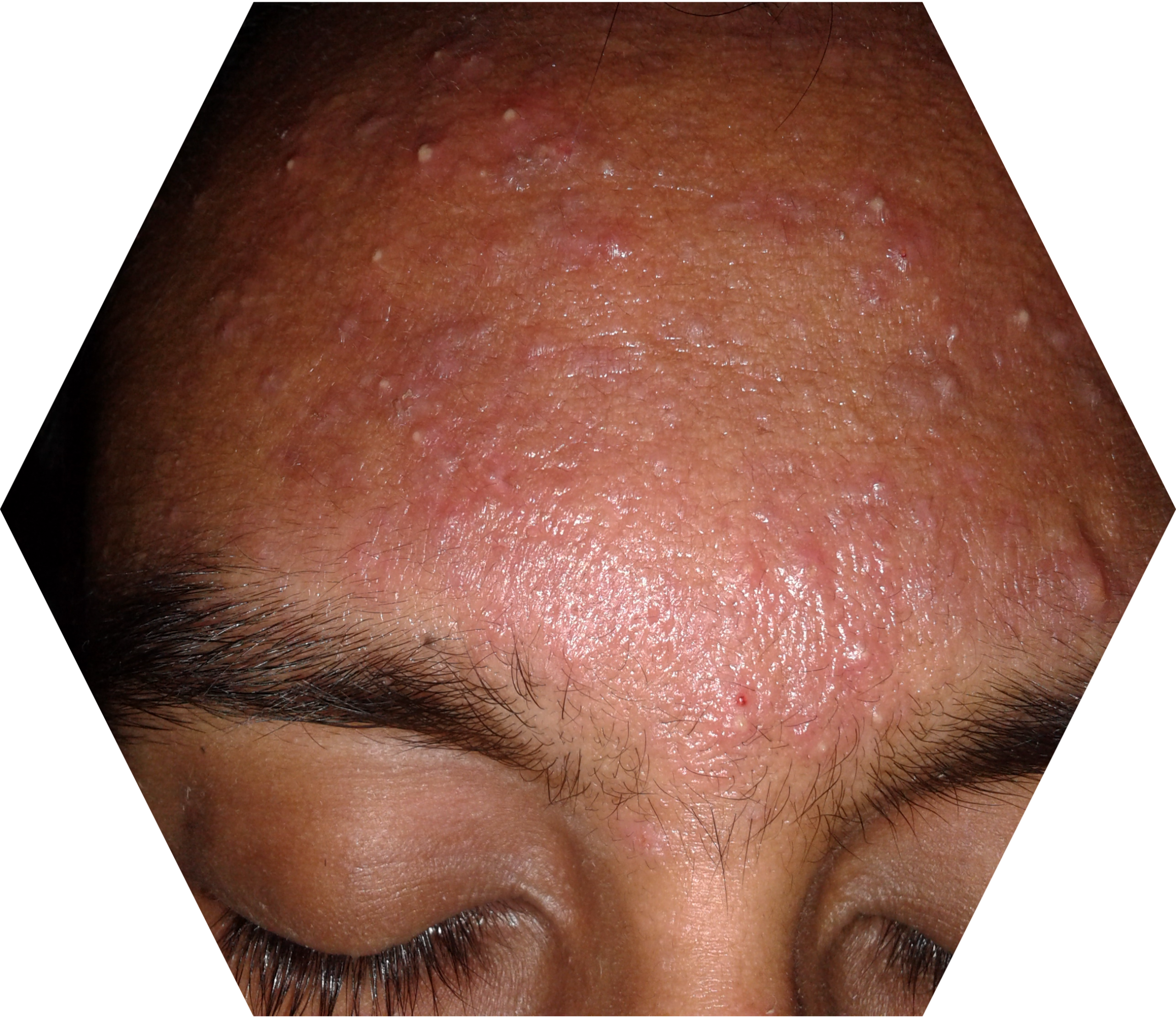 Acne papulopustulosa