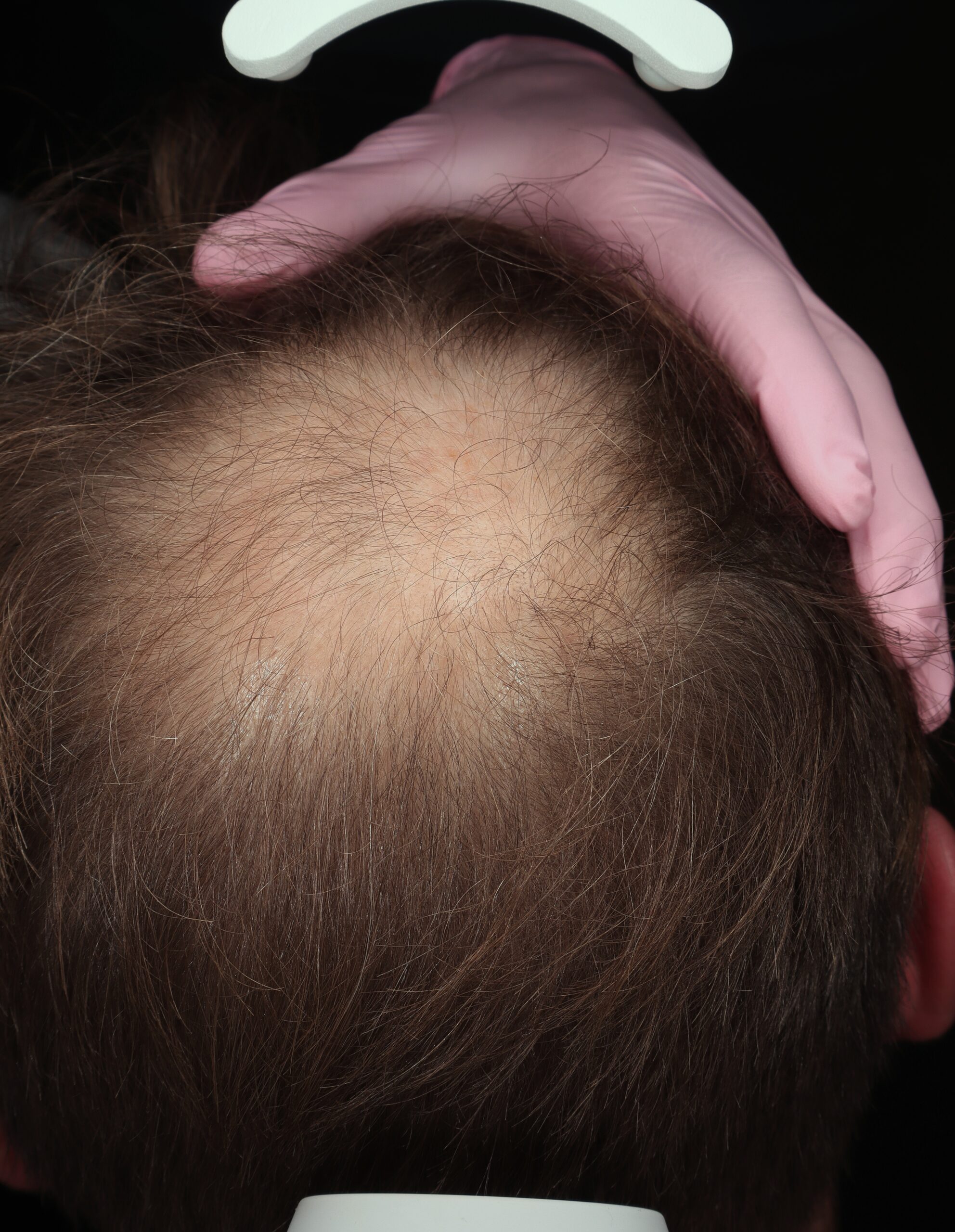 Alopecia androgenetica