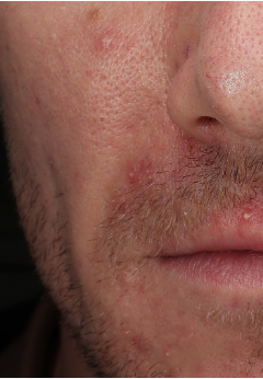 acne actief before
