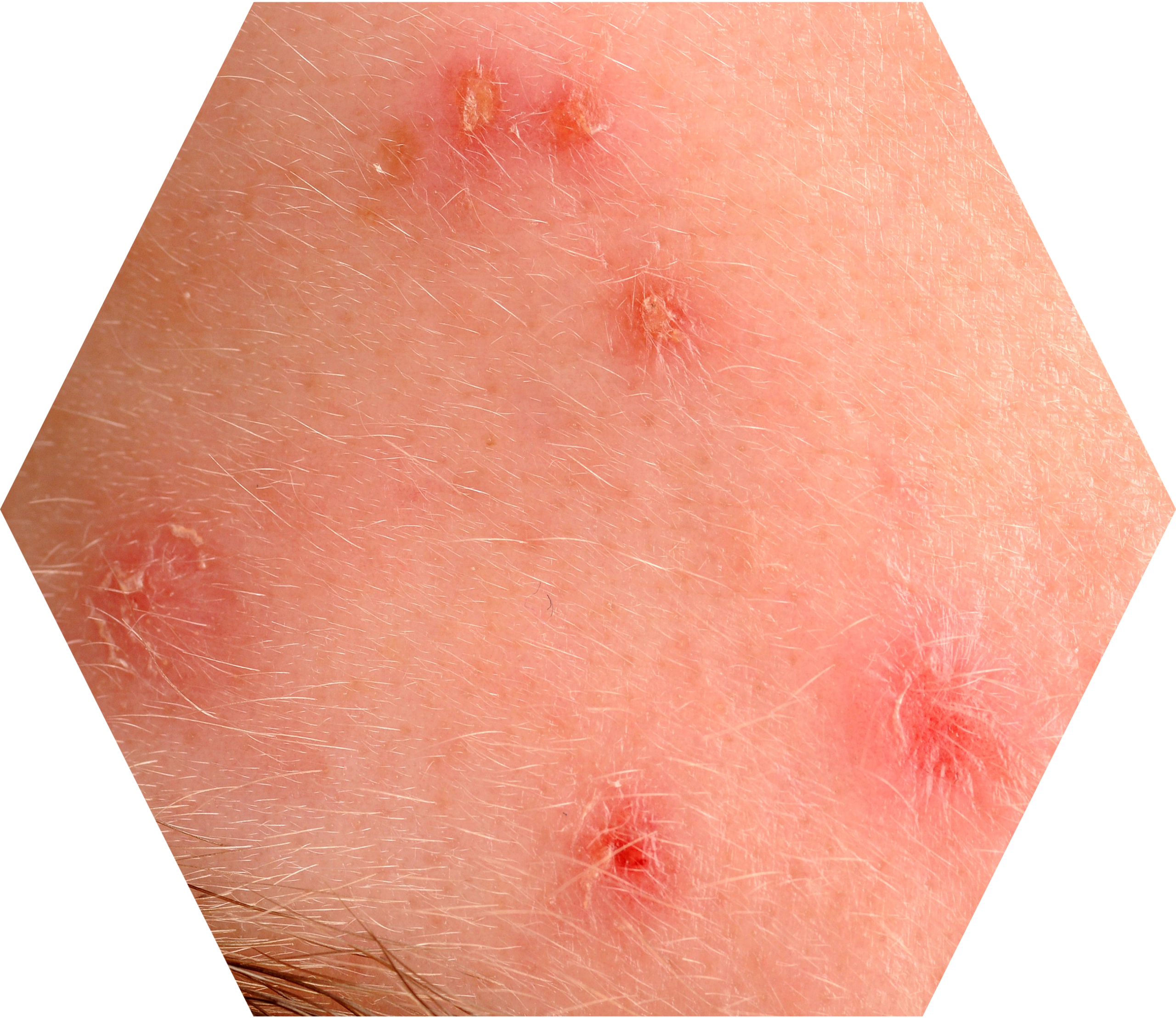acne excorieé