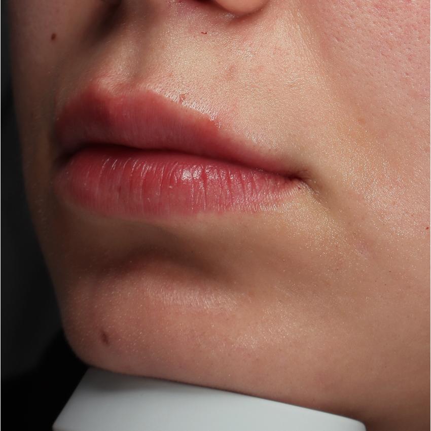 Lippen zijkant NA