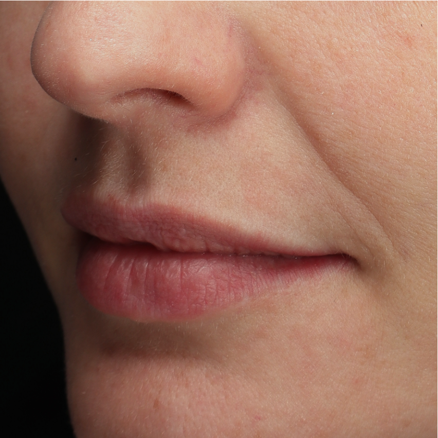 Neus-lippenplooi