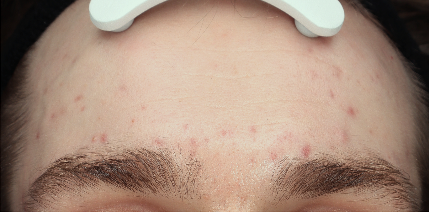 Acne foto - voor behandeling